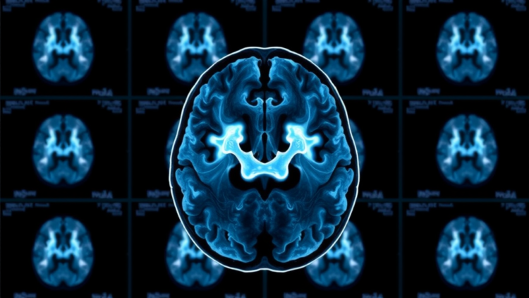 SPECT Rivals PET in Head-to-Head Test of Parkinson’s Brain Scans