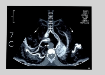 Landmark Chinese Consensus Sets First Global Standard for Ultrasound-Guided Lung Biopsy