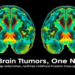 Two Brain Tumors, One Name: Molecular Map Redefines Childhood Posterior Fossa Ependymoma