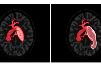 MRI Reveals Aortic Stiffness Links to Aneurysm Risk in Large Population Study