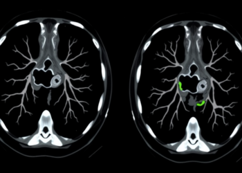 Rare Congenital Lung Anomaly Masquerades as a Lookalike Condition on CT Scans