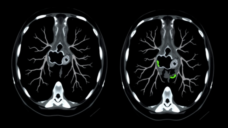 Rare Congenital Lung Anomaly Masquerades as a Lookalike Condition on CT Scans