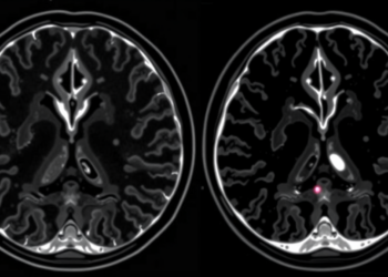 MRI Scoring System Shows Promise for Telling Benign From Malignant Breast Lesions