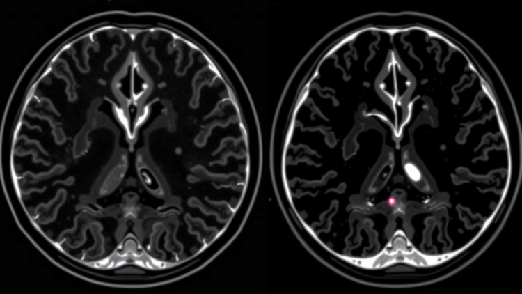 MRI Scoring System Shows Promise for Telling Benign From Malignant Breast Lesions