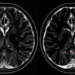 MRI Scoring System Shows Promise for Telling Benign From Malignant Breast Lesions