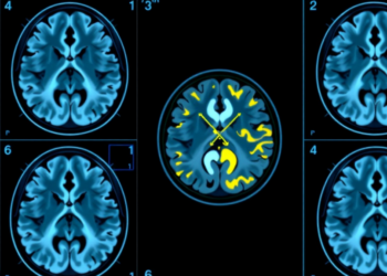 Amyloid in the Cerebellum Is Quietly Corrupting Alzheimer’s PET Scans