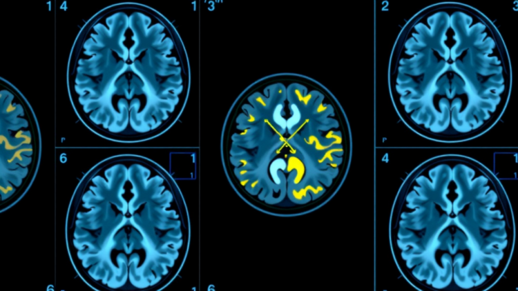 Amyloid in the Cerebellum Is Quietly Corrupting Alzheimer’s PET Scans