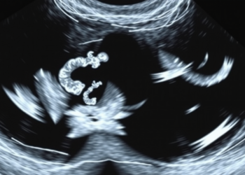 Ultrasound Is Replacing X-Ray Imaging for Pediatric Volvulus, but Only in Some Countries