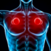 Muscle Fat, Not Muscle Mass, May Signal Early Setbacks in Radioactive Tumor Therapy