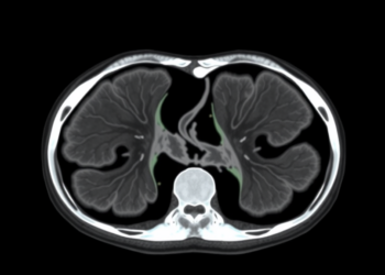 Mamba-Based AI Sharpens Medical Image Segmentation With Position Awareness and Dynamic Upsampling