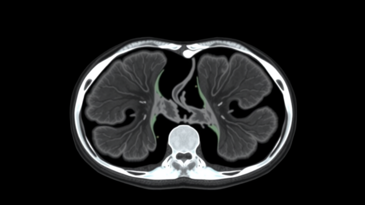 Mamba-Based AI Sharpens Medical Image Segmentation With Position Awareness and Dynamic Upsampling