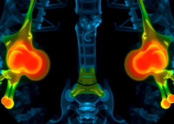 Ultrasound Atlas of Healthy Childhood Entheses Could Transform Juvenile Arthritis Diagnosis