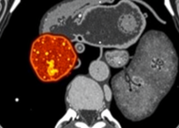 Rare Colon Metastasis From Aggressive Thyroid Cancer Spotted by FDG PET/CT