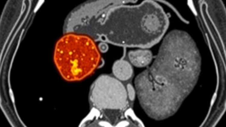 Rare Colon Metastasis From Aggressive Thyroid Cancer Spotted by FDG PET/CT