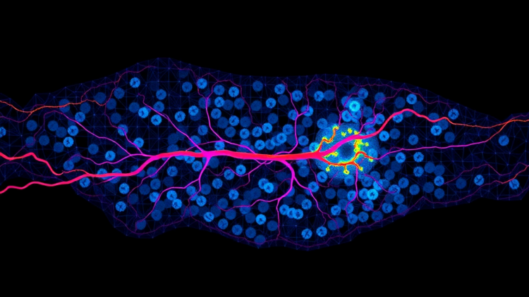 Single-Cell Map Reveals Vascular Barrier That Predicts BCG Failure in Bladder Cancer