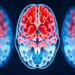Blood Group O Linked to Longer Survival in MGMT-Methylated Glioblastoma Patients