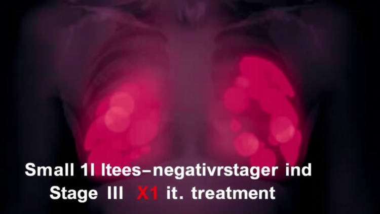 Small Triple-Negative Breast Tumors Blur the Line Between Stage I and Stage II Treatment