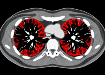 AI Reads Routine CT Scans to Predict Dangerous Immunotherapy Lung Inflammation Before It Starts