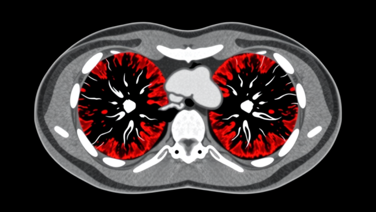 AI Reads Routine CT Scans to Predict Dangerous Immunotherapy Lung Inflammation Before It Starts