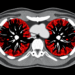 AI Reads Routine CT Scans to Predict Dangerous Immunotherapy Lung Inflammation Before It Starts