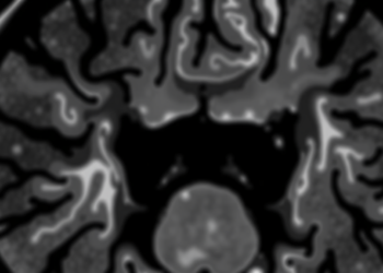 When Experts Trace the Same Tumor: Study Reveals Hidden Variability in CT Tumor Outlines