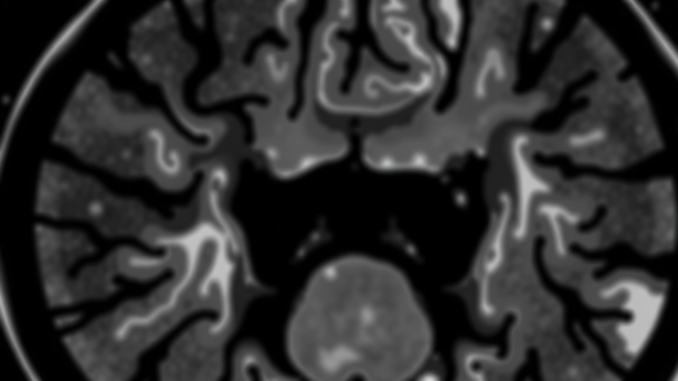 When Experts Trace the Same Tumor: Study Reveals Hidden Variability in CT Tumor Outlines