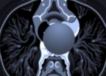 CT Calcium Scans May Predict Who Benefits Most From Mitral Valve Balloon Procedure