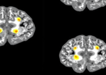 AI Model Predicts Where Glioblastoma Will Return Before MRI Can See It