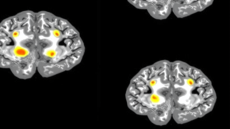 AI Model Predicts Where Glioblastoma Will Return Before MRI Can See It