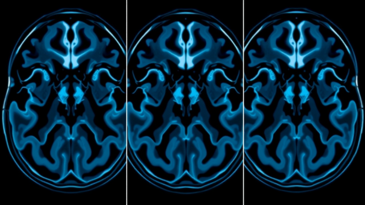 MRI Study Splits Bone Growth Stage Into Three Substages to Sharpen Forensic Age Tests