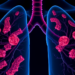 Rare POLE P286R-Mutated Lung Cancer Shows Dramatic Response to Immunotherapy