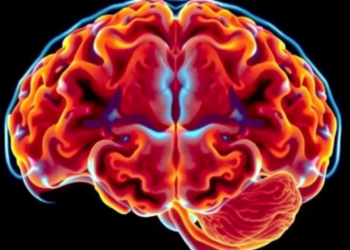 AI Predicts Brain Shift During Epilepsy Surgery Using Only Pre-Operative Scans