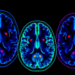 Blood-Brain Barrier Leaks Distort Brain Tumor PET Scans, Mouse Study Reveals