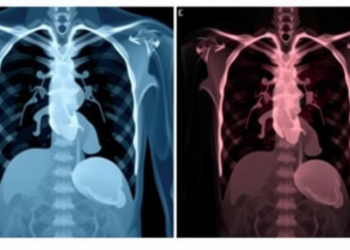 Chest Muscle Size on Preoperative Scans Predicts Bleeding Risk After Mastectomy
