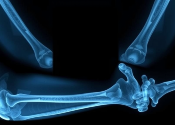 Hidden Elbow Fracture in Babies: One X-ray Clue Stands Out, Study Finds