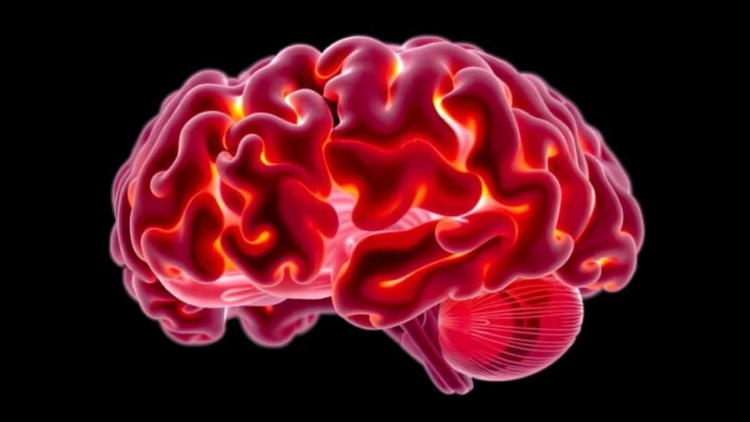 Rare Brain Germ Cell Tumors in Adults Often Masquerade as Pituitary Inflammation, Study Finds