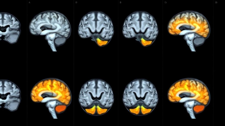 Mixed-Effects Model for Brain Scans Matches Gold Standard and Maps Reliability Across the Whole Brain