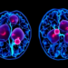Machine Learning Model Predicts Three-Year Survival in Rare Blood Cancer