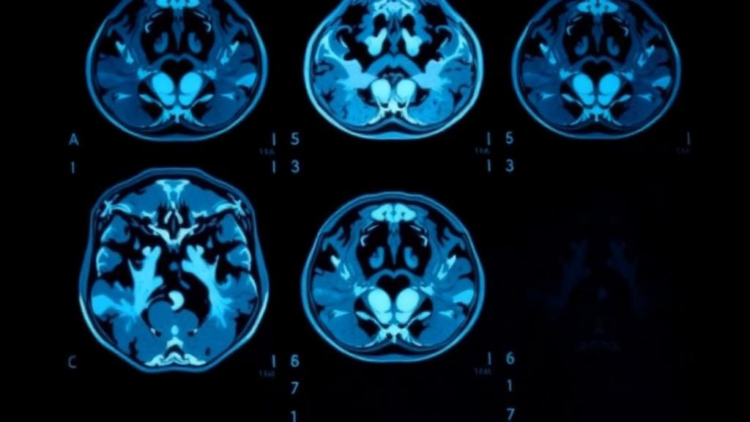 New AI Framework Teaches Itself to Read Medical Scans With Fewer Labels