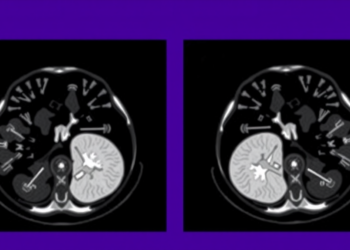 New Nectin-4-Targeted PET Scan Outperforms FDG in Aggressive Breast Cancer