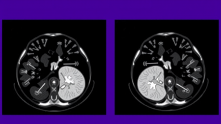 New Nectin-4-Targeted PET Scan Outperforms FDG in Aggressive Breast Cancer