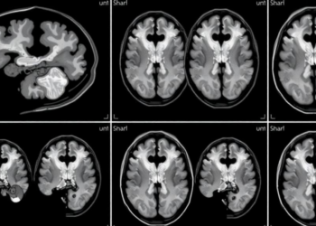 Tiny Brain Spaces on Newborn Scans May Predict Sleep Trouble Years Later