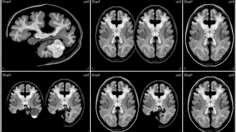 Tiny Brain Spaces on Newborn Scans May Predict Sleep Trouble Years Later