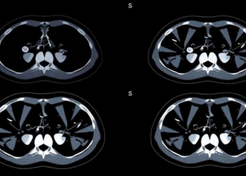 AI Learns to Rebuild CT Scans Without Ever Seeing a Single Ground-Truth Image