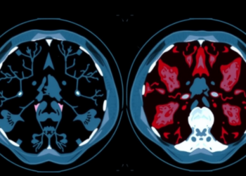 AI Reads CT Scans to Tell Two Deadly Sarcomas Apart