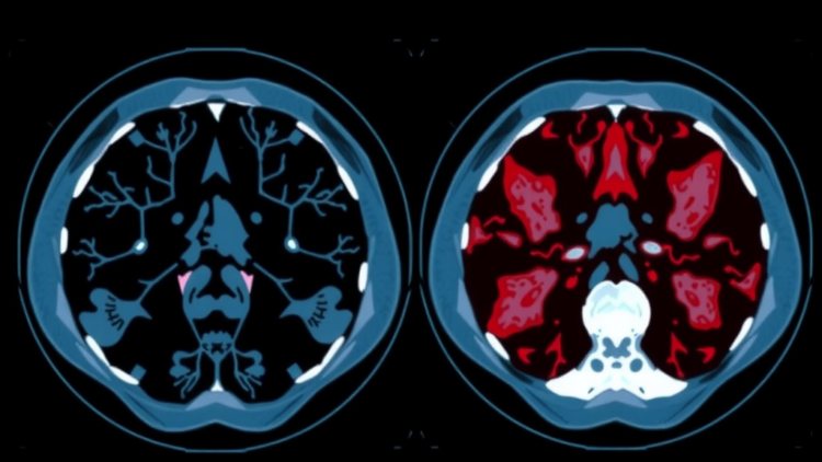 AI Reads CT Scans to Tell Two Deadly Sarcomas Apart