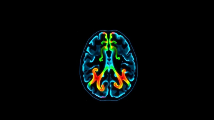 RNA Acetylation Enzyme NAT10 Helps Glioblastoma Resist Radiotherapy
