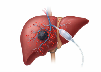 Balloon Catheters Fail to Boost Tumor Targeting in Holmium-166 Radioembolization Trial