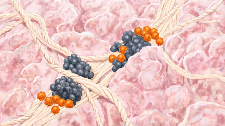 AI maps collagen highways and myeloid roadblocks that trap T cells in pancreatic cancer