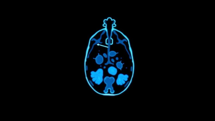 PET Imaging Reveals Whether Immunotherapy Drugs Actually Reach Their Tumour Targets